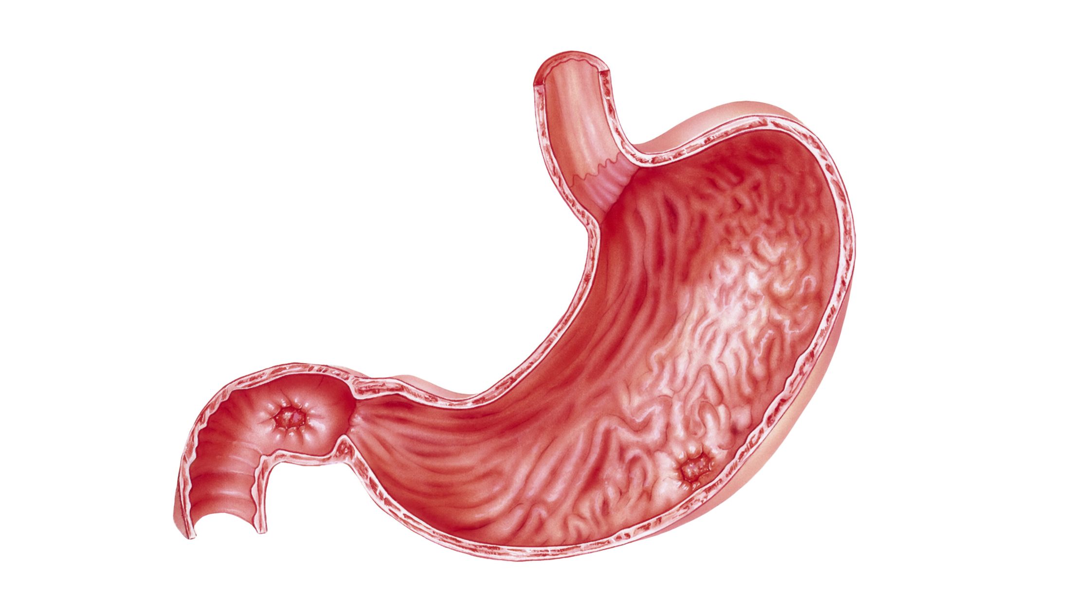 peptic ulcers