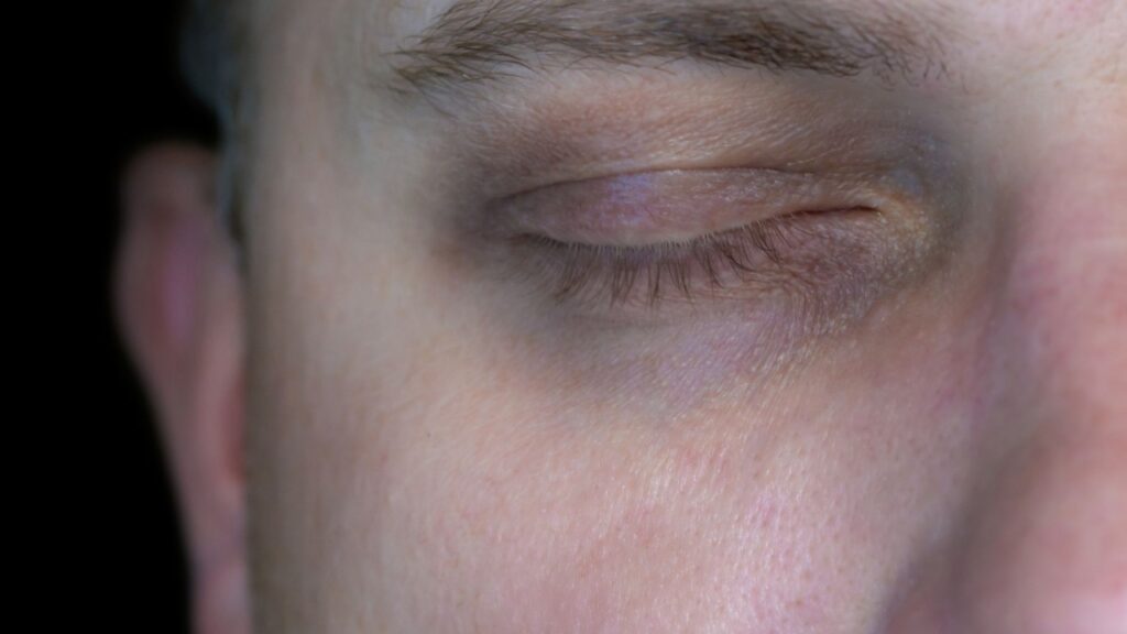 Dark Circles