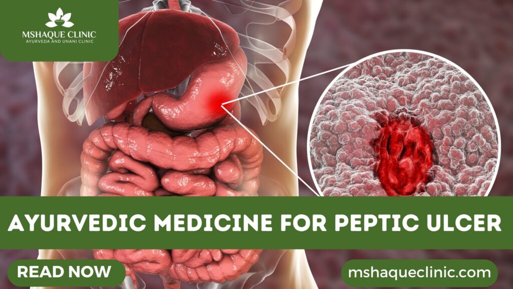 Ayurvedic Medicine For Peptic Ulcer