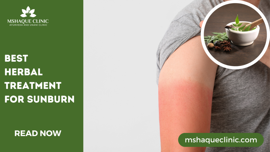 Best Herbal Treatment For Sunburn